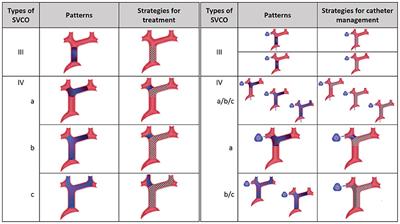 Insights Into Endovascular Management of Superior Vena Cava Obstructions